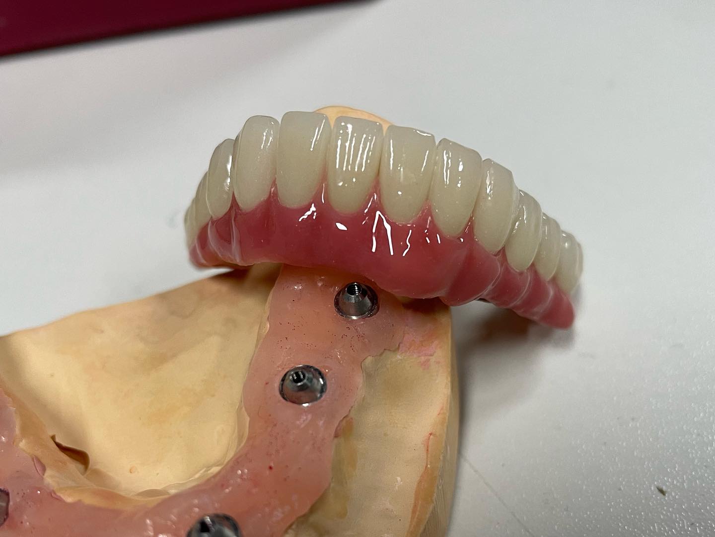 Full-Arch?Dental Im