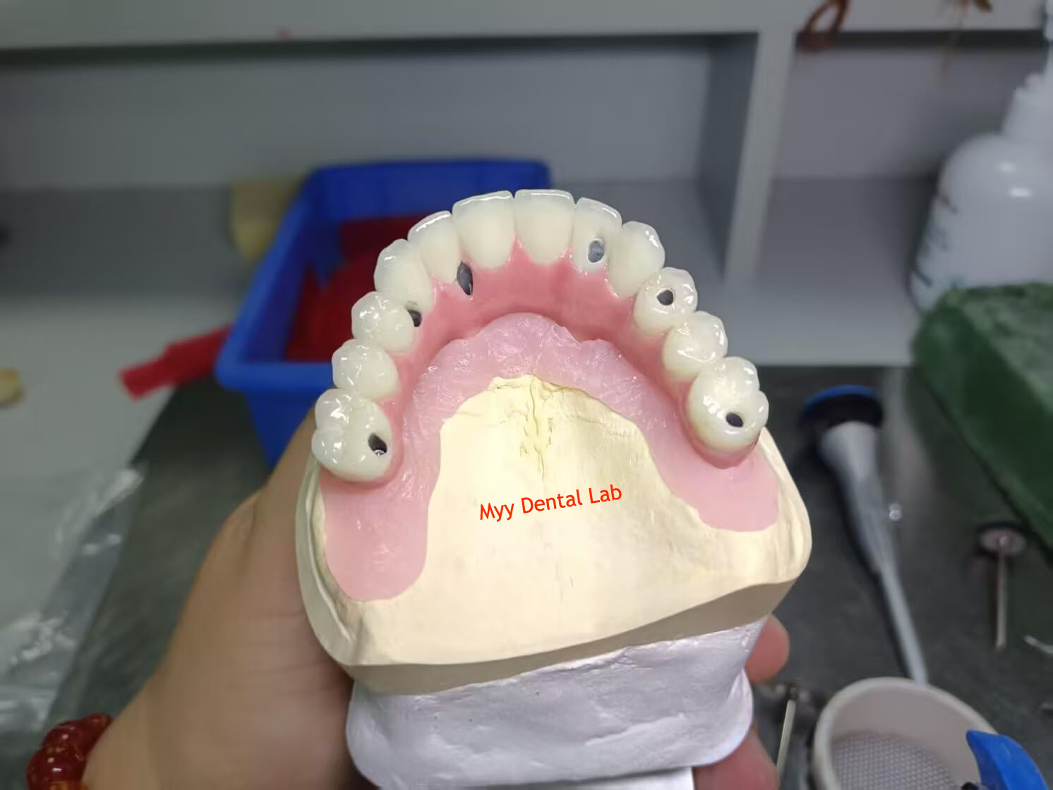 Screw-Retained Denta